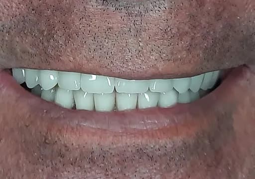 Drg.Herman Jaya Atmaja, Sp.Pros | Fullmouth Rehabilitation | Veneer and Dental Esthetic | Dental Implant - Main Image