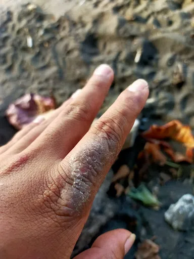 Dokter Spesialis Kulit dan Kelamin Singaraja dr I Komang Harry Sp.KK 3