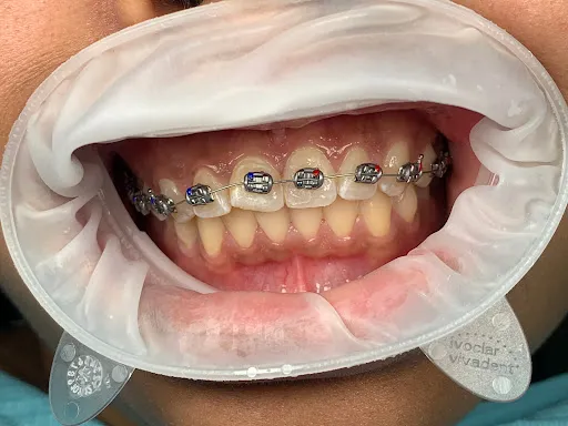 Ubud dentist - Carla Dental 4